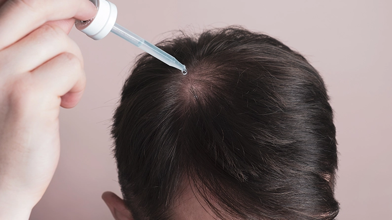 Hair loss problem. Man applying dropper with minoxidil or serum. Baldness treatment concept, genetic alopecia. Closeup, top view