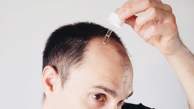 Hair loss treatment for men concept. Young caucasian man looking at mirror and applying anti-hair loss concentrate serum for regrow hair, close up. Baldness, alopecia in males.